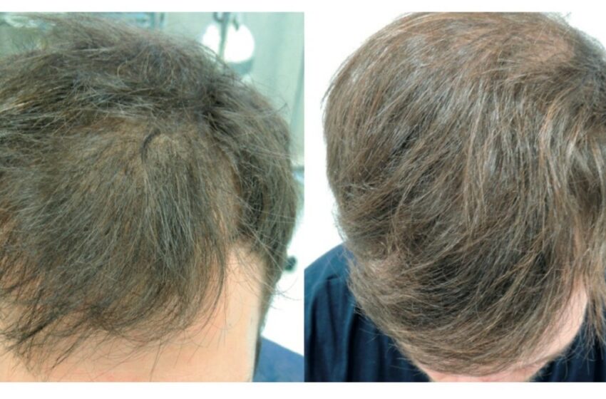  Tratamiento de Regeneración Celular en Alopecia